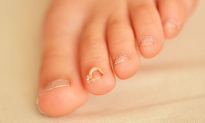nail infections in monsoons go mommy